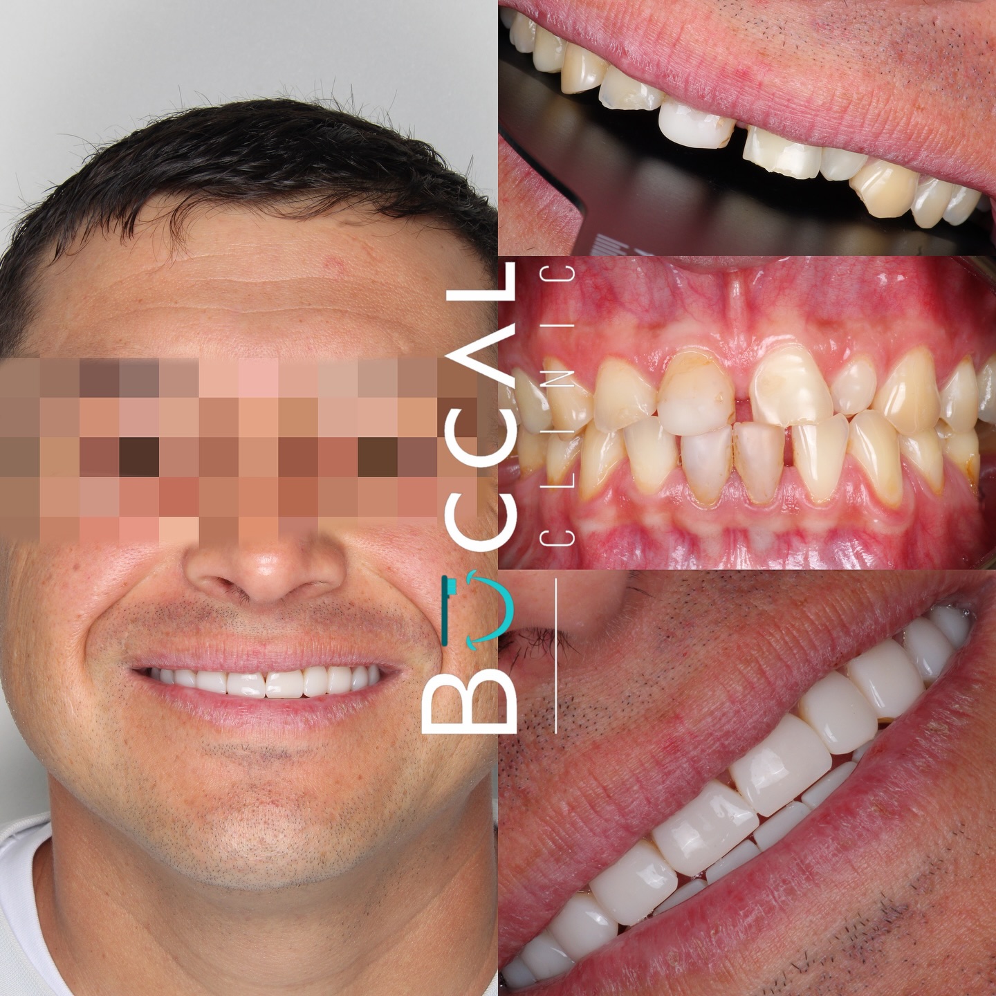 Diseño de sonrisa resultado