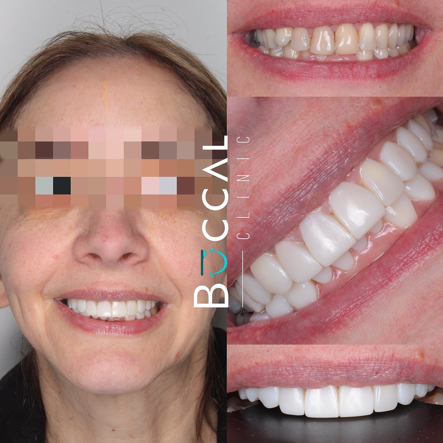 Implantes dentales