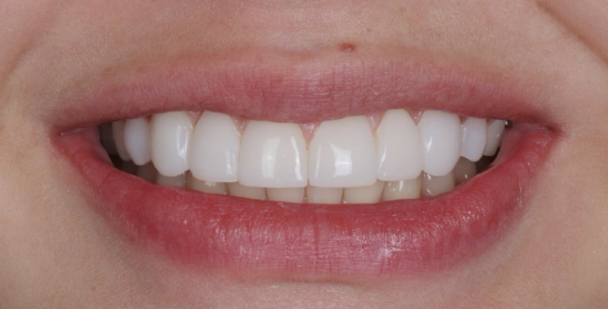 Antes