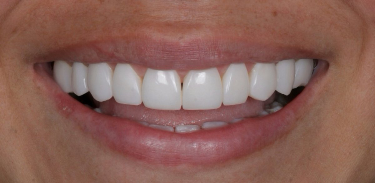 Antes