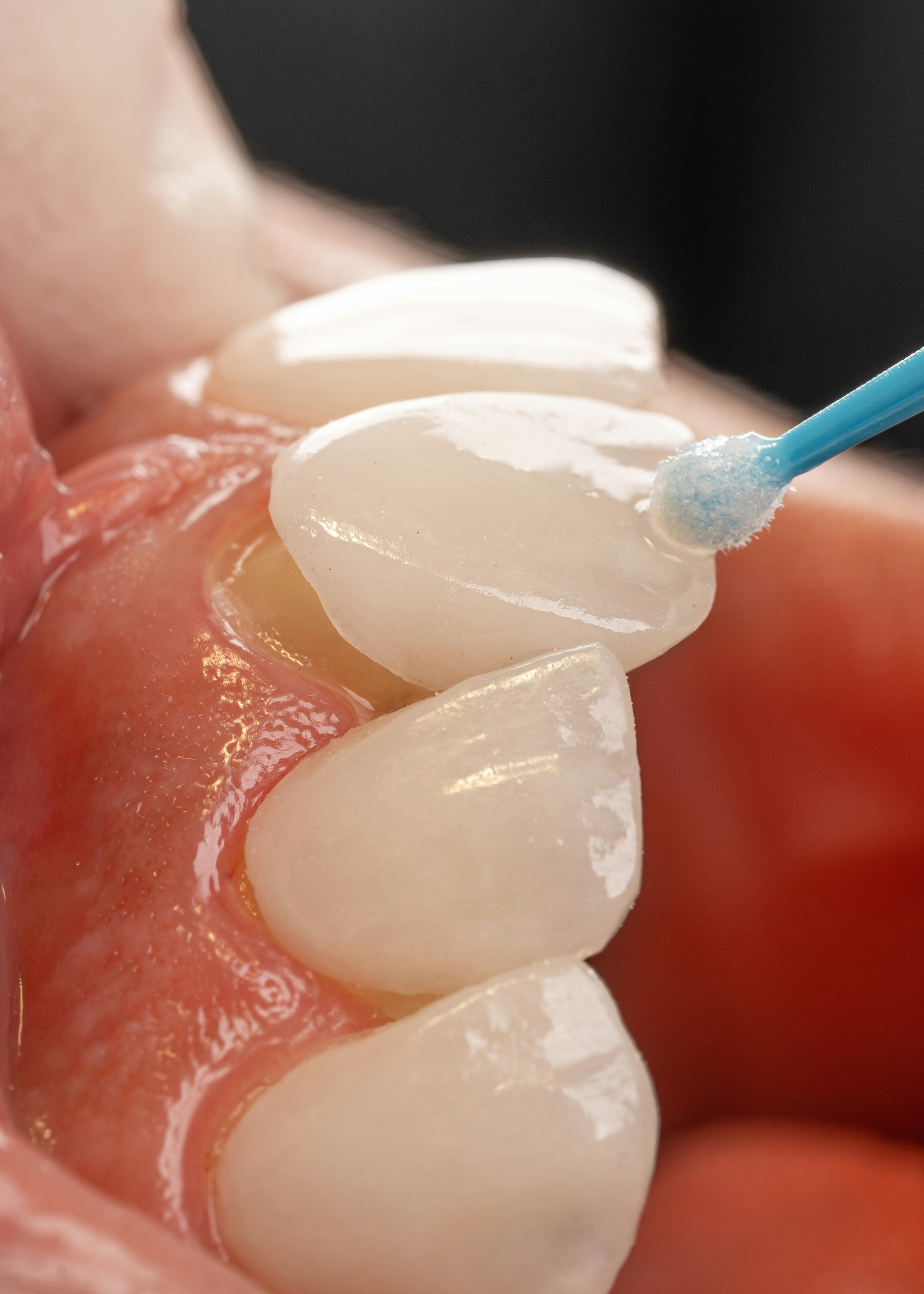 Carillas Dentales Buccal Clinic